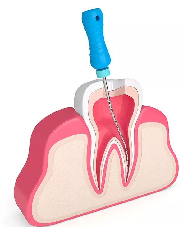 3D animated image of root canal procedure showing the cross section of the tooth