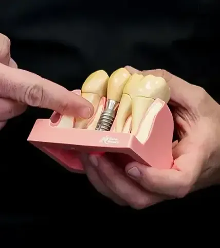 Dental implant model showing a cross section of three teeth with a single titanium dental implant. 