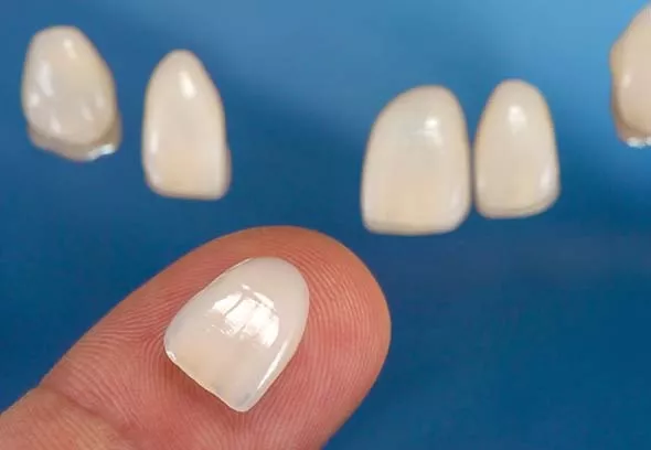 Close up of veneers
