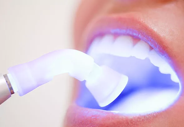 Close up of teeth whitening 