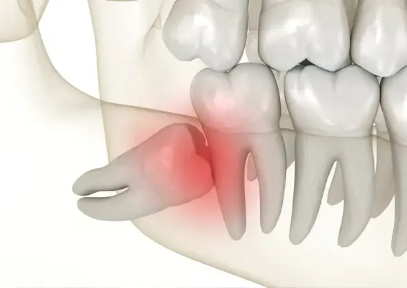 Rendering of impacted wisdom tooth