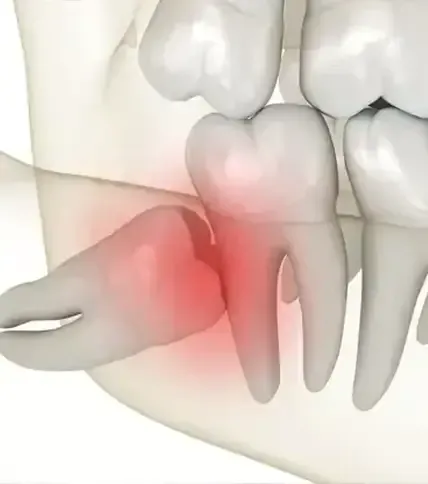 Rendering of impacted wisdom tooth